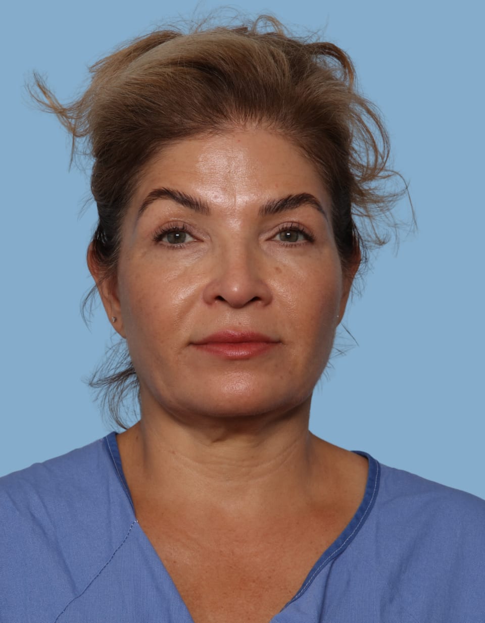Blepharoplasty after - front view