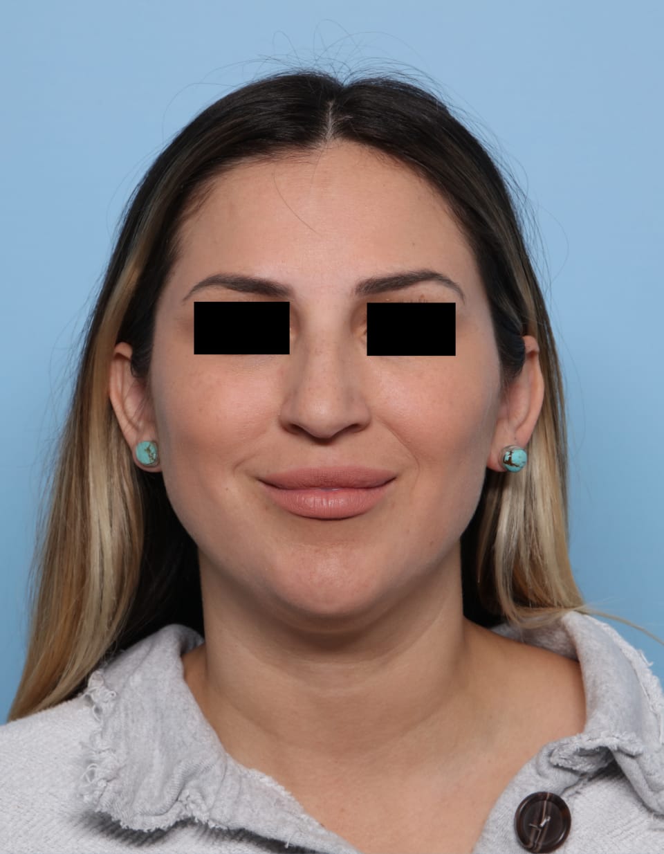 Rhinoplasty before - front view