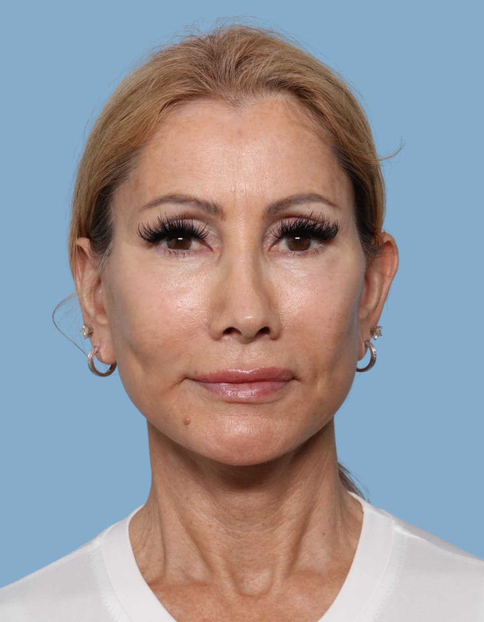 Facelift after - front view