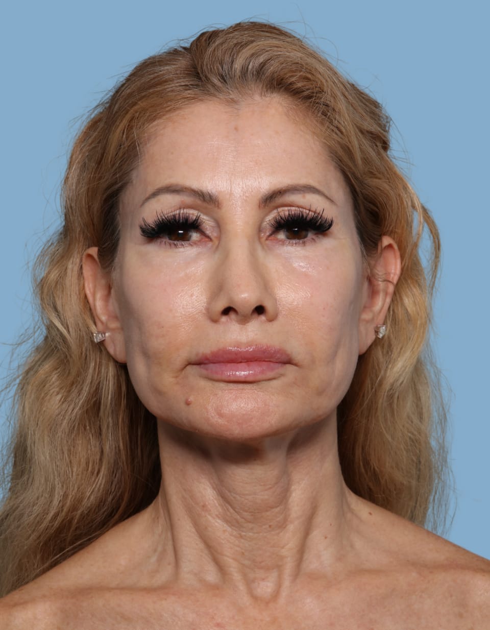Facelift before - front view