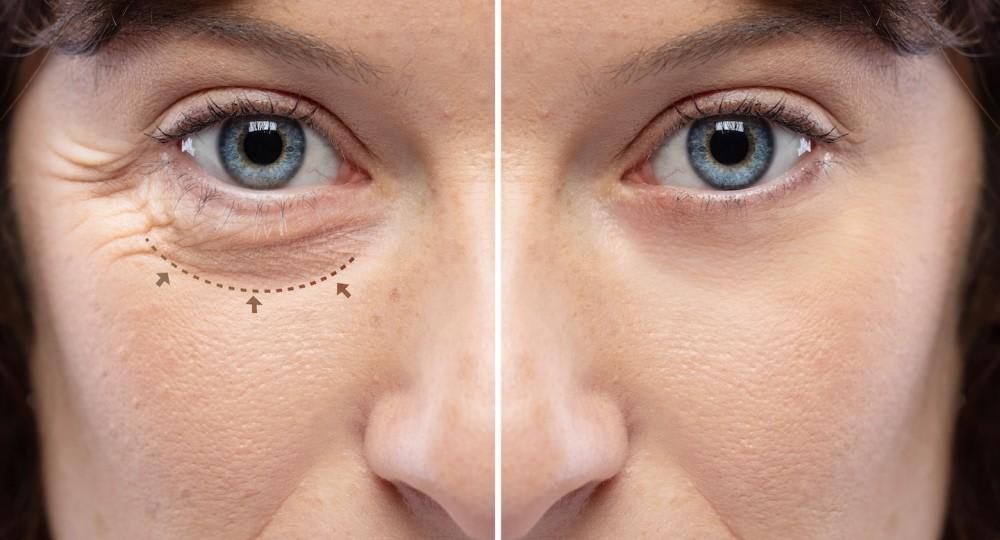 Why Blepharoplasty Is the #1 Eye Rejuvenation Procedure