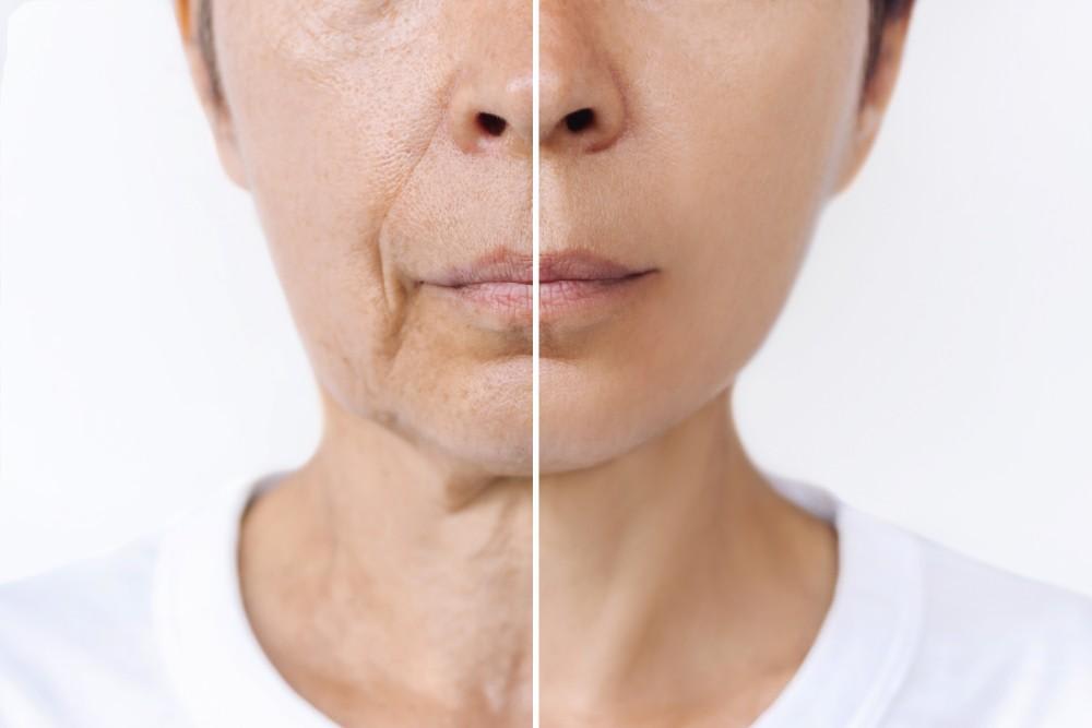 Everything You Need to Know About Deep Plane Facelift Sur...