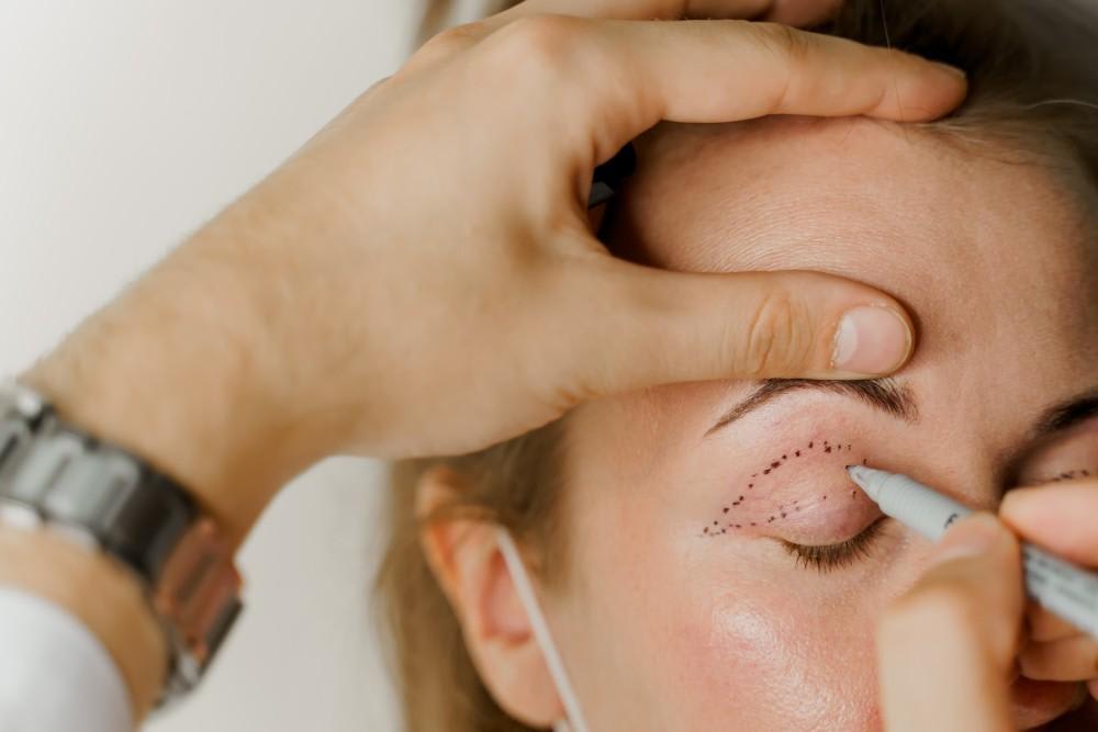 What Is Blepharoplasty? Benefits, Risks, Recovery, and Re...