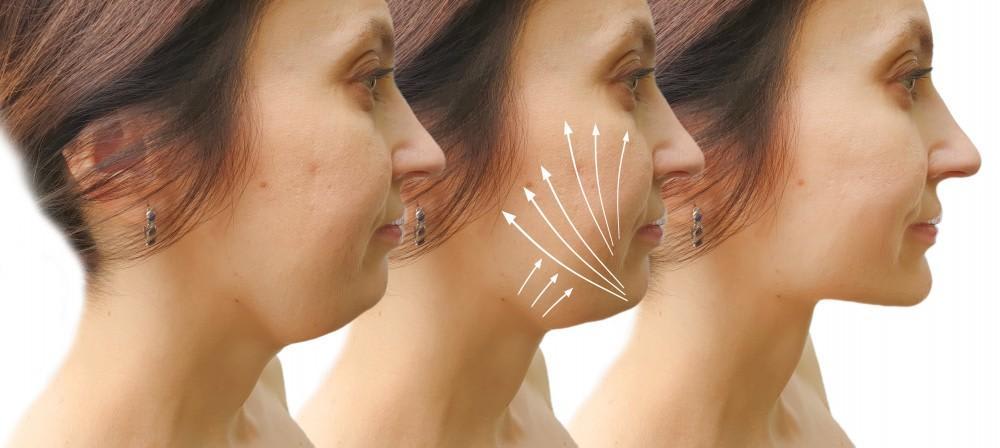 Why the Deep Plane Facelift Will Be Considered the Gold S...