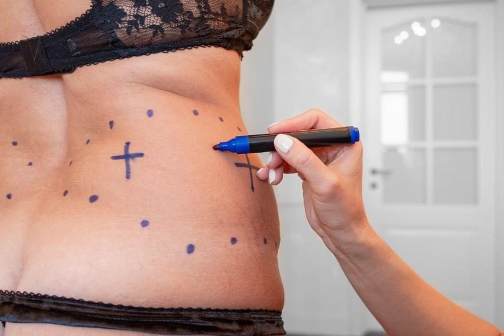 Here's How to Choose the Right Time for Your Mommy Makeover