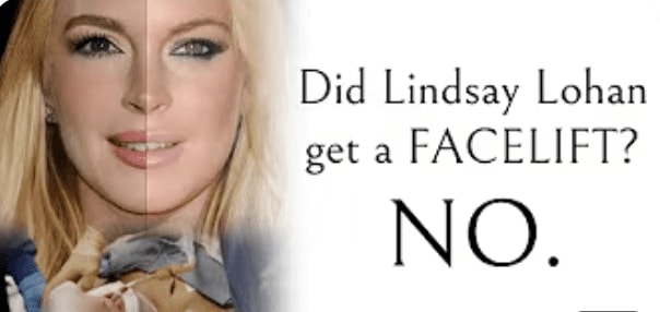 Did Lindsay Lohan get a FACELIFT? NO.