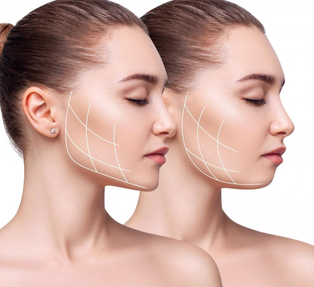 The Keys to a Successful and Natural-Looking Facelift
