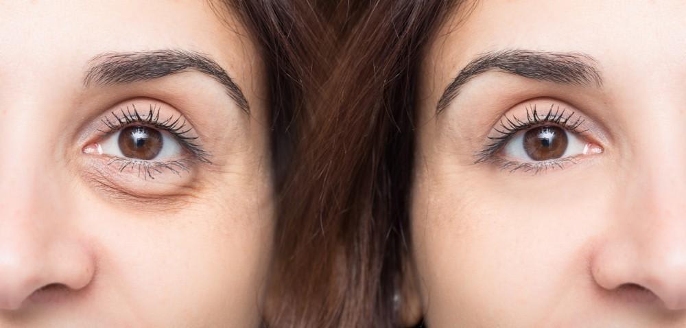 Do Under-Eye Bags Make You Look Tired? How Our Blepharopl...