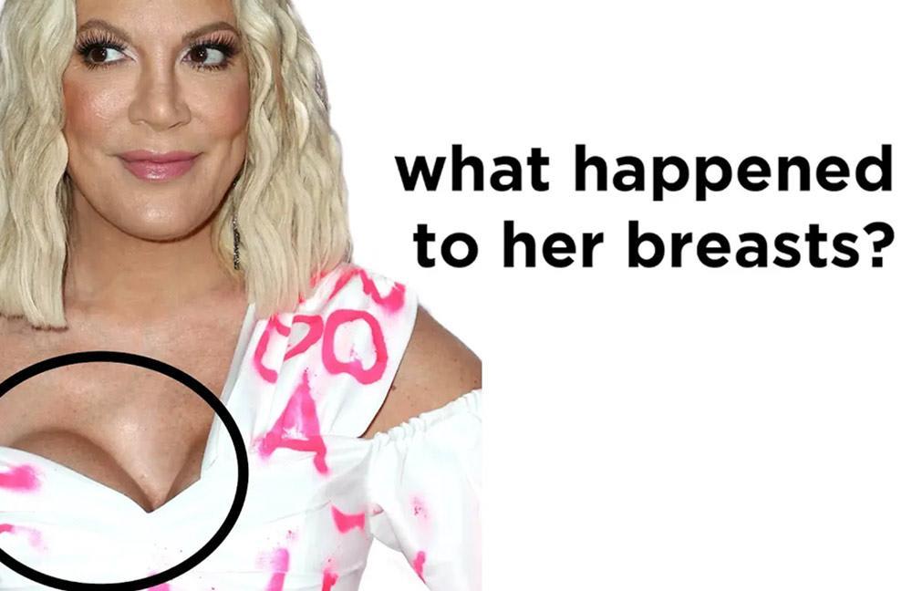 Capsular Contracture | Are My Breast Implants Botched?