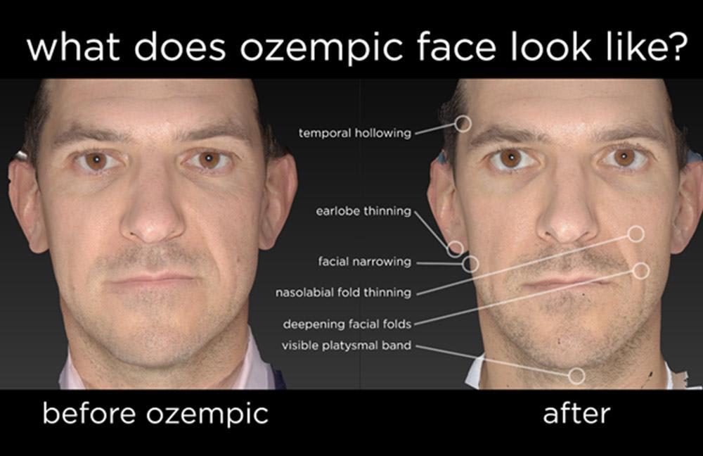 Ozempic for Weight Loss: What is Ozempic Face?