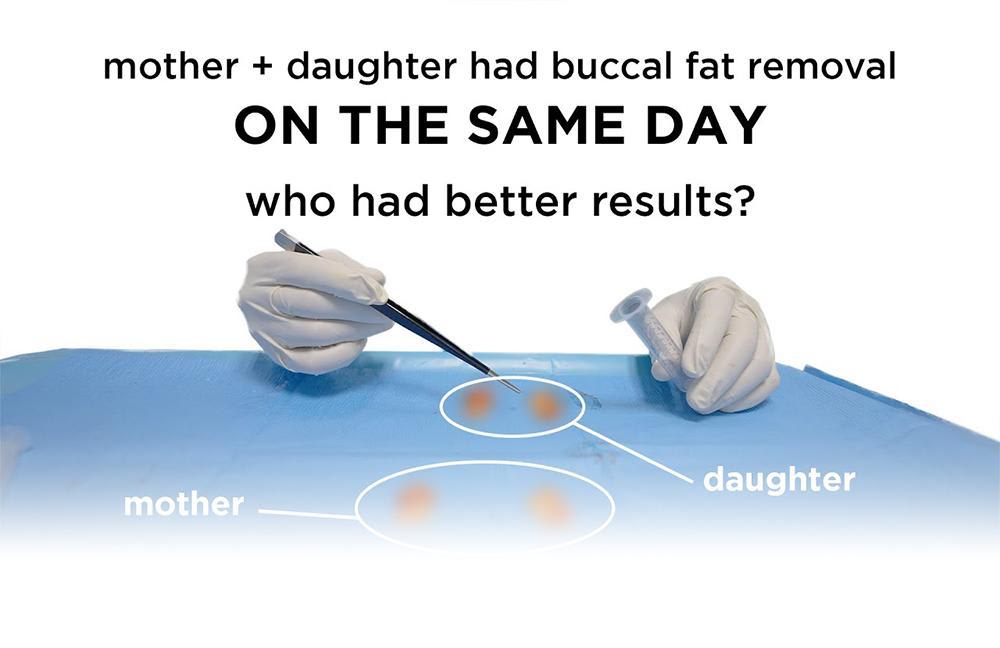 Regret Buccal Fat Removal in 20 Years? Mother Daughter Co...