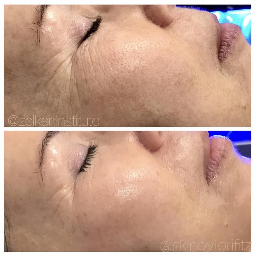 Why Hydrafacial is So Popular