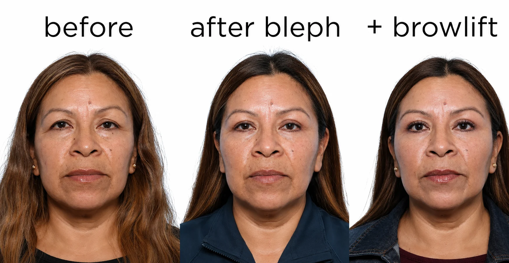 Heavy lids? Taking blepharoplasty (eyelid lift) to the NEXT LEVEL with a single-stitch brow lift
