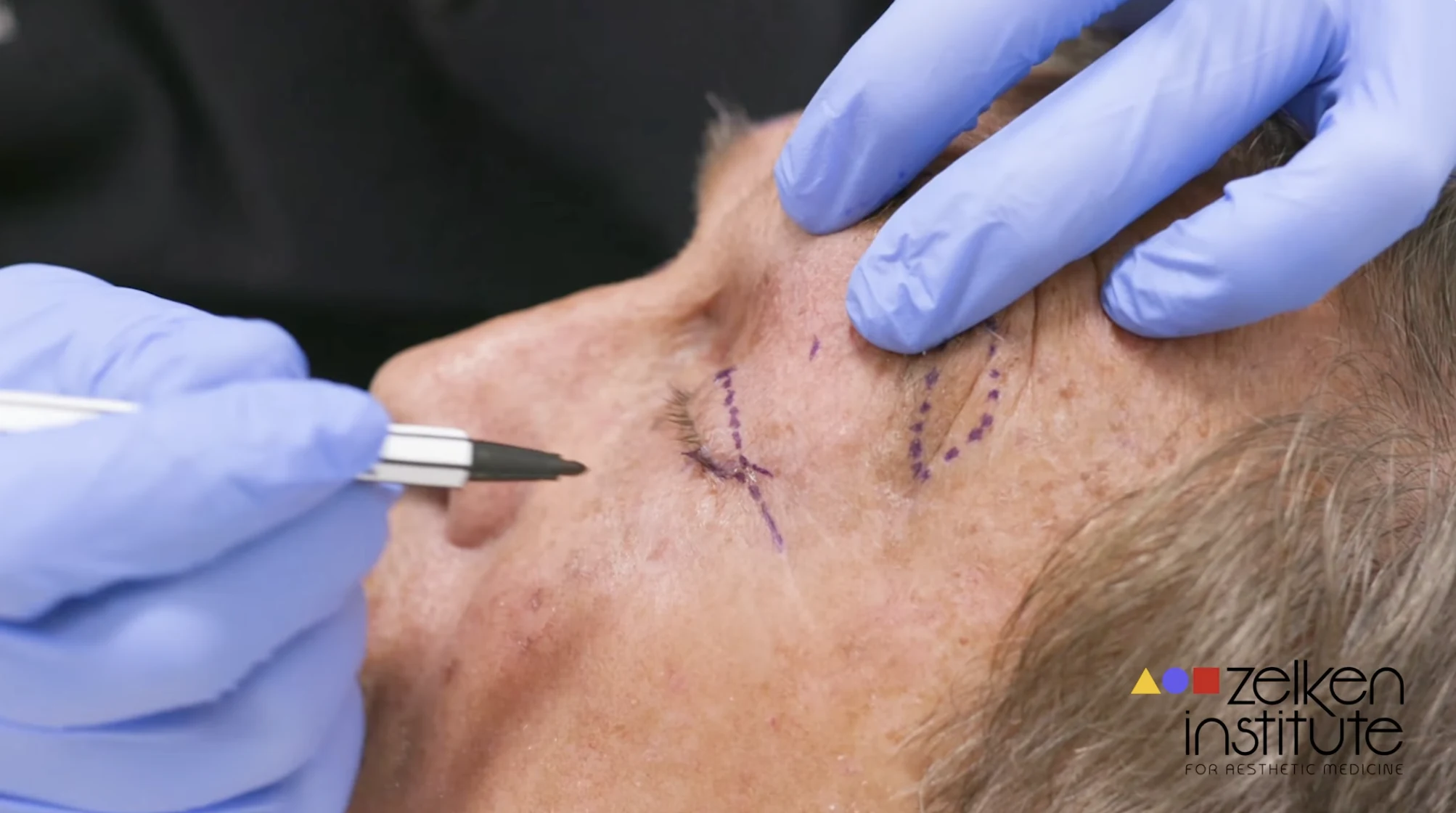 Wide Awake Quadruple Blepharoplasty Browlift Skin Cancer Excision CO2 Laser Newport Beach Dr Zelken
