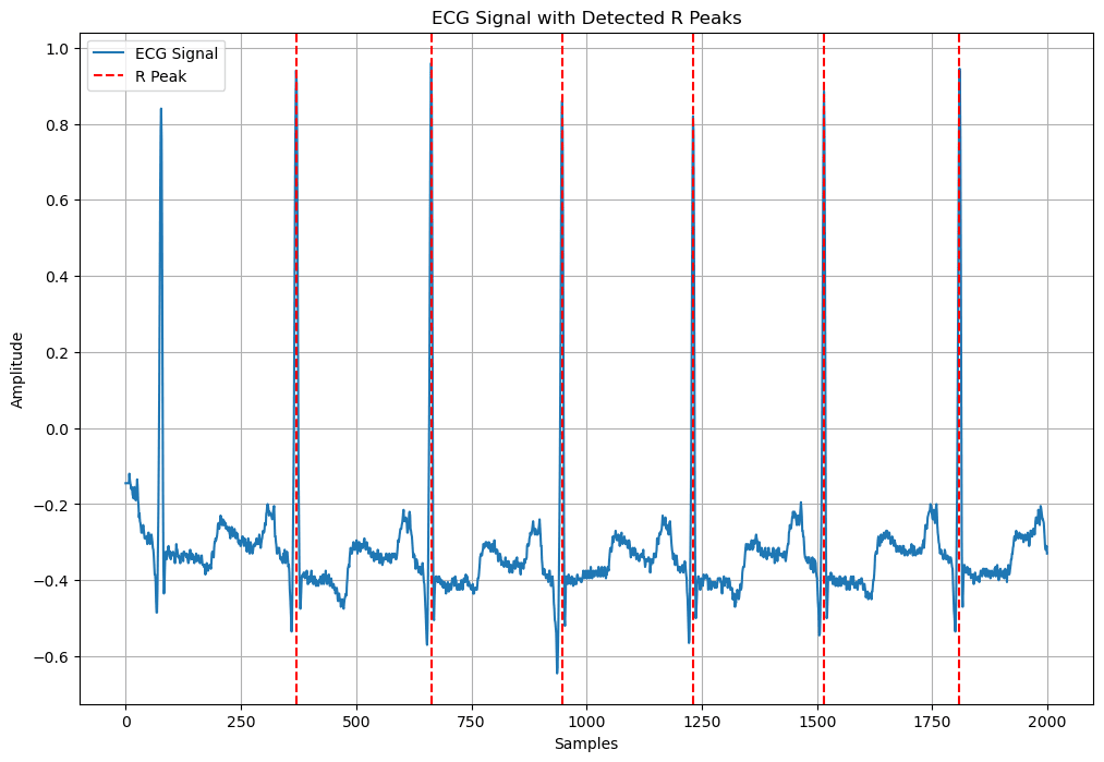 ECG QRS