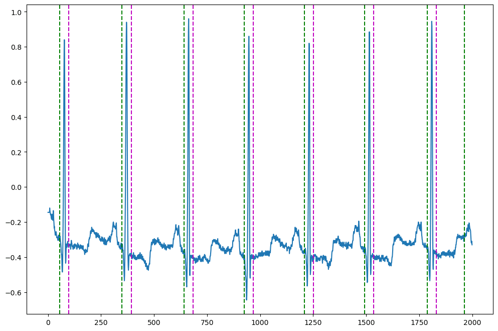 ECG QRS