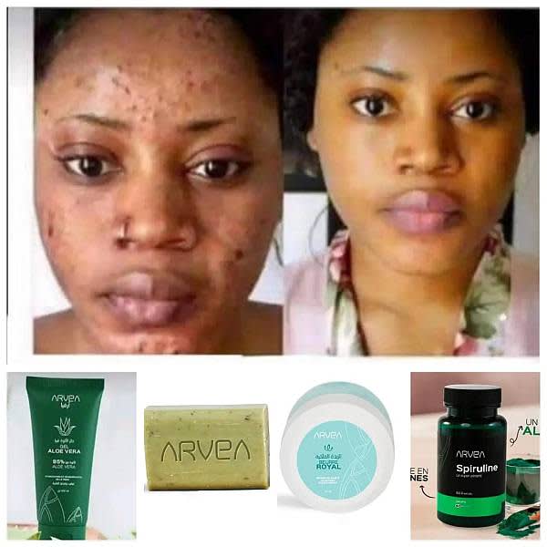 Aloe Vera Savon miracle contre bouton