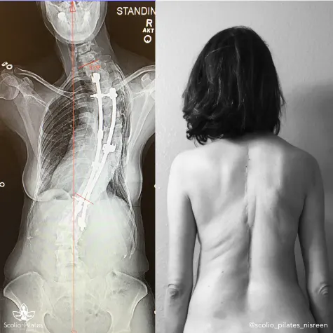 Side-by-side image showing a spinal fusion x-ray with hardware next to a black-and-white photo of a bare back, illustrating one woman's scoliosis journey with Scolio-Pilates