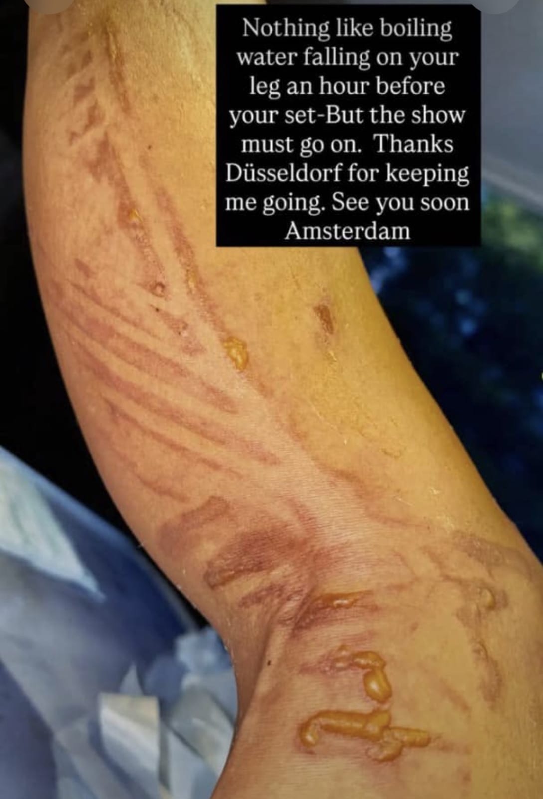 Nicole Scherzinger yakomerekejwe n’amazi abira mbere ho isaha ngo ajye ku rubyin photo